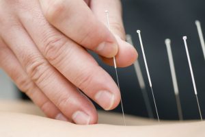Acupuncture dry needling