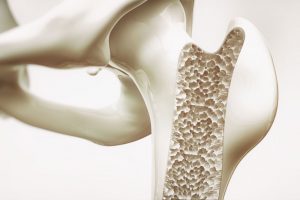 Image of bone affected by osetoporosis