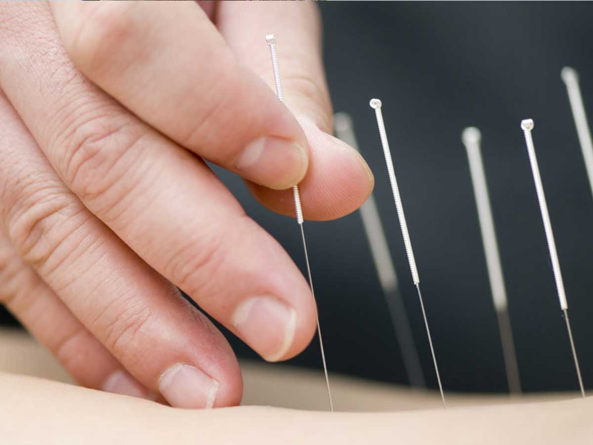 Physiotherapy dry needling